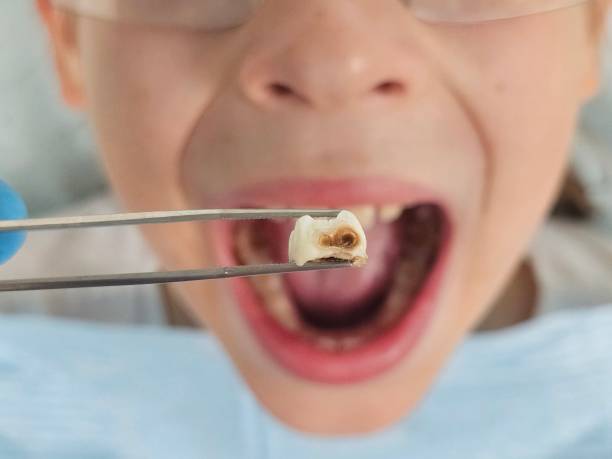 Best Emergency Broken Tooth Repair in Severn, MD
